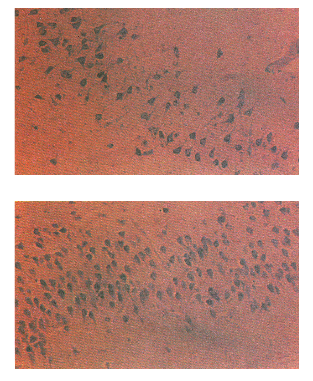 Видно {вверху), что нейроны гиппокампа, окрашенные в фиолетово-коричневатый цвет, отличаются ненормальной формой и расположением, а число их меньше, чем у нормального индивидуума того же возраста (внизу).